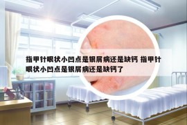 指甲针眼状小凹点是银屑病还是缺钙 指甲针眼状小凹点是银屑病还是缺钙了
