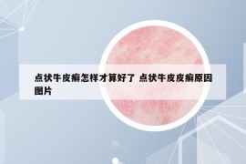 点状牛皮癣怎样才算好了 点状牛皮皮癣原因图片