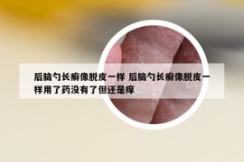 后脑勺长癣像脱皮一样 后脑勺长癣像脱皮一样用了药没有了但还是痒
