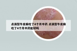 点滴型牛皮癣吃了4个月中药 点滴型牛皮癣吃了4个月中药能好吗