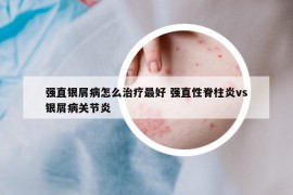 强直银屑病怎么治疗最好 强直性脊柱炎vs银屑病关节炎