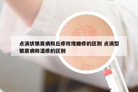 点滴状银屑病和丘疹玫瑰糠疹的区别 点滴型银屑病和湿疹的区别