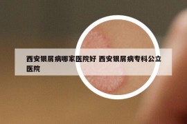 西安银屑病哪家医院好 西安银屑病专科公立医院