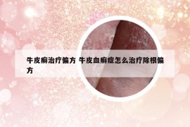 牛皮癣治疗偏方 牛皮血癣症怎么治疗除根偏方