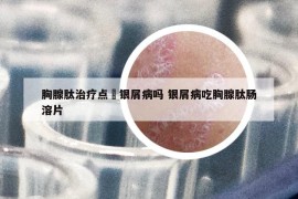 胸腺肽治疗点滳银屑病吗 银屑病吃胸腺肽肠溶片