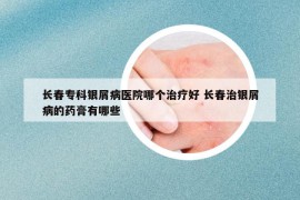 长春专科银屑病医院哪个治疗好 长春治银屑病的药膏有哪些