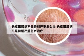 头皮银屑病不是特别严重怎么治 头皮银屑病不是特别严重怎么治疗