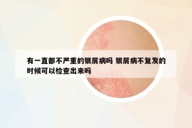 有一直都不严重的银屑病吗 银屑病不复发的时候可以检查出来吗