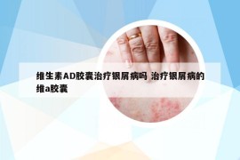 维生素AD胶囊治疗银屑病吗 治疗银屑病的维a胶囊
