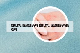他扎罗汀是激素药吗 他扎罗汀是激素药吗能吃吗