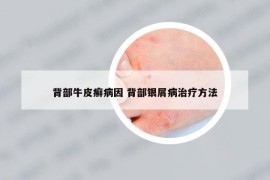 背部牛皮癣病因 背部银屑病治疗方法