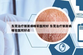 东莞治疗银屑病哪家医院好 东莞治疗银屑病哪家医院好点
