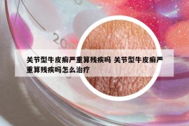 关节型牛皮癣严重算残疾吗 关节型牛皮癣严重算残疾吗怎么治疗