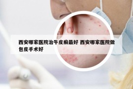 西安哪家医院治牛皮癣最好 西安哪家医院做包皮手术好