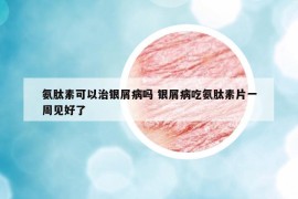 氨肽素可以治银屑病吗 银屑病吃氨肽素片一周见好了