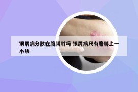 银屑病分散在胳膊肘吗 银屑病只有胳膊上一小块