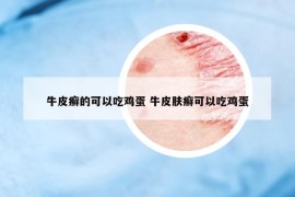 牛皮癣的可以吃鸡蛋 牛皮肤癣可以吃鸡蛋
