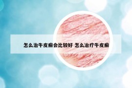怎么治牛皮癣会比较好 怎么冶疗牛皮癣