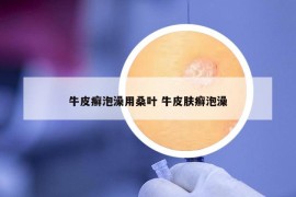 牛皮癣泡澡用桑叶 牛皮肤癣泡澡