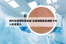 同时鱼鳞病和银屑病 鱼鳞病跟银屑病哪个对人的危害大