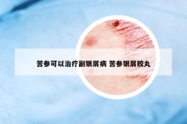 苦参可以治疗副银屑病 苦参银屑胶丸