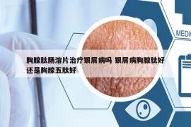 胸腺肽肠溶片治疗银屑病吗 银屑病胸腺肽好还是胸腺五肽好