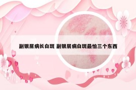 副银屑病长白斑 副银屑病白斑最怕三个东西