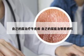 自己的尿治疗牛皮癣 自己的尿能治银屑病吗