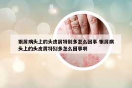银屑病头上的头皮屑特别多怎么回事 银屑病头上的头皮屑特别多怎么回事啊