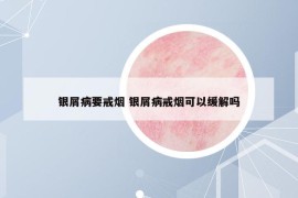 银屑病要戒烟 银屑病戒烟可以缓解吗