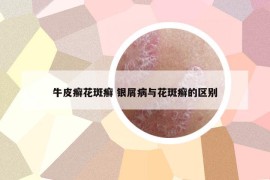 牛皮癣花斑癣 银屑病与花斑癣的区别