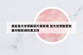 美能复方甘草酸苷片银屑病 复方甘草酸苷胶囊对银屑病效果怎样