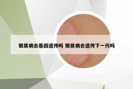 银屑病会基因遗传吗 银屑病会遗传下一代吗