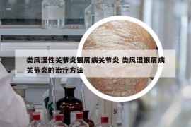 类风湿性关节炎银屑病关节炎 类风湿银屑病关节炎的治疗方法