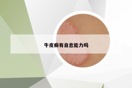 牛皮癣有自愈能力吗