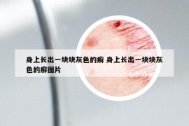 身上长出一块块灰色的癣 身上长出一块块灰色的癣图片