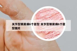 关节型银屑病6个亚型 关节型银屑病6个亚型图片