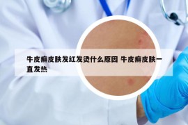 牛皮癣皮肤发红发烫什么原因 牛皮癣皮肤一直发热