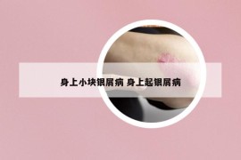 身上小块银屑病 身上起银屑病