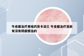 牛皮廨治疗用啥药膏卡泊三 牛皮廨治疗目前有没有彻底根治的