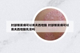 肘部银屑病可以用夫西地酸 肘部银屑病可以用夫西地酸乳膏吗