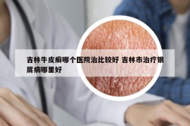 吉林牛皮癣哪个医院治比较好 吉林市治疗银屑病哪里好