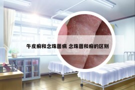 牛皮癣和念珠菌病 念珠菌和癣的区别
