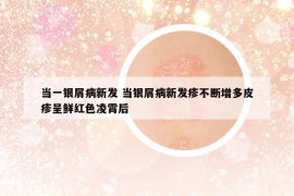 当一银屑病新发 当银屑病新发疹不断增多皮疹呈鲜红色凌霄后