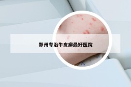 郑州专治牛皮癣最好医院