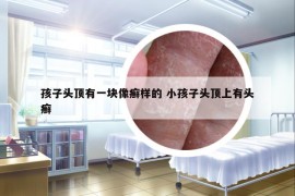 孩子头顶有一块像癣样的 小孩子头顶上有头癣