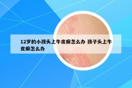 12岁的小孩头上牛皮癣怎么办 孩子头上牛皮癣怎么办