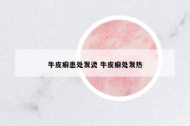牛皮癣患处发烫 牛皮癣处发热