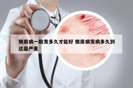 银屑病一般发多久才能好 银屑病发病多久到达最严重