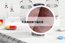 牛皮癣皮肤下暗红色
